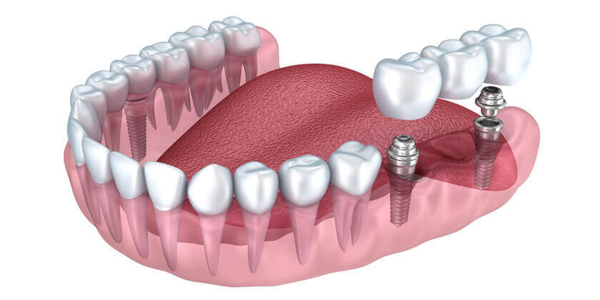 Impantbrücke - Zahnimplantate